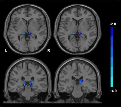 Sex Differences in Re-experiencing Symptoms Between Husbands and Wives Who Lost Their Only Child in China: A Resting-State Functional Connectivity Study of Hippocampal Subfields